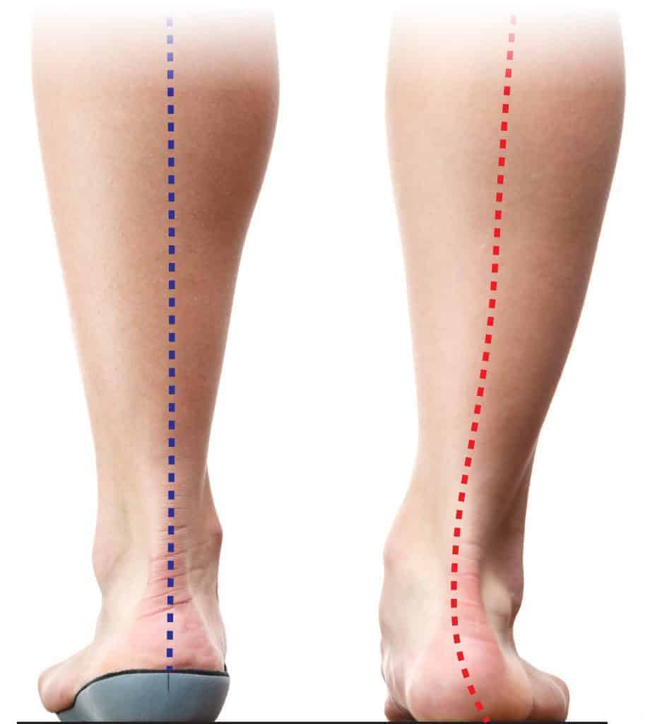 Running Orthotic Before and After