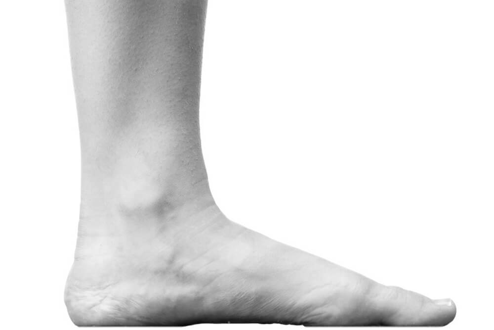 Picture of Flat Feet