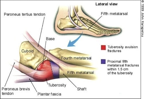Paediatric Lateral Foot Pains illustration