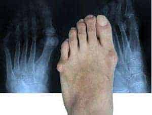 Tailor's Bunions foot comparing with xray