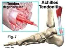 Illustration of Achilles Tendon