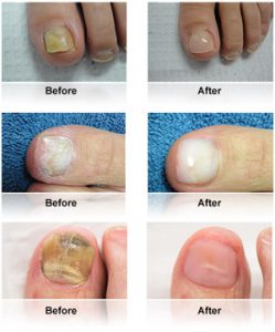 keryflex nail restoration examples before and after