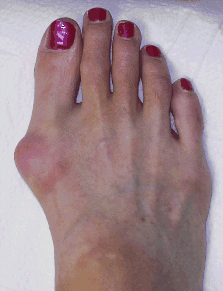Woman's feet swollen with bunions