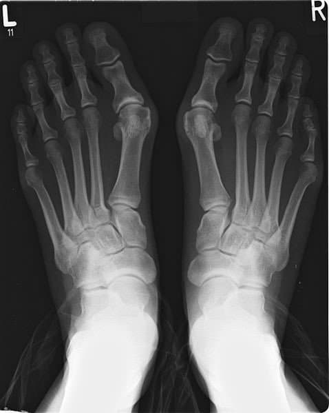 bunions-x-ray of feet with bunions-001