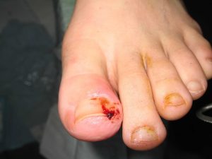 ingrown toenail cut into flesh and cause bleeding