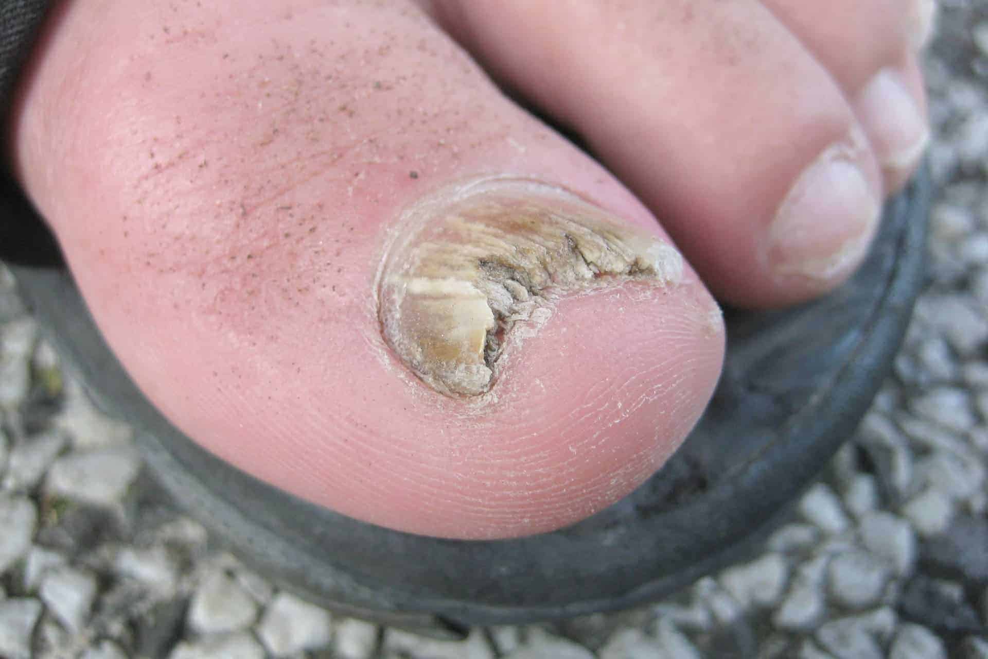 featured image - Toenail Problem: An Important Guide to Understanding Your Condition