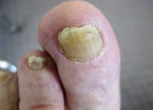 toenail infected by fungal
