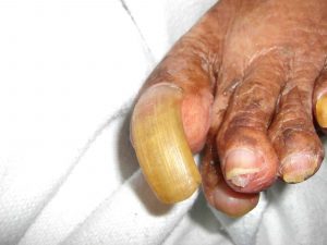 thickedned toenail that has overgrown