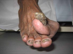 thickened toenail that has overgrowned and infected