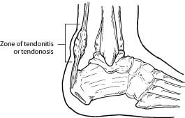 graphic illustration of tendonitis