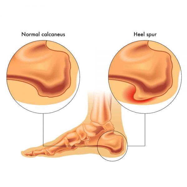 My FootDr Singapore: Conditions manageed - Illustration of Heel Spurs
