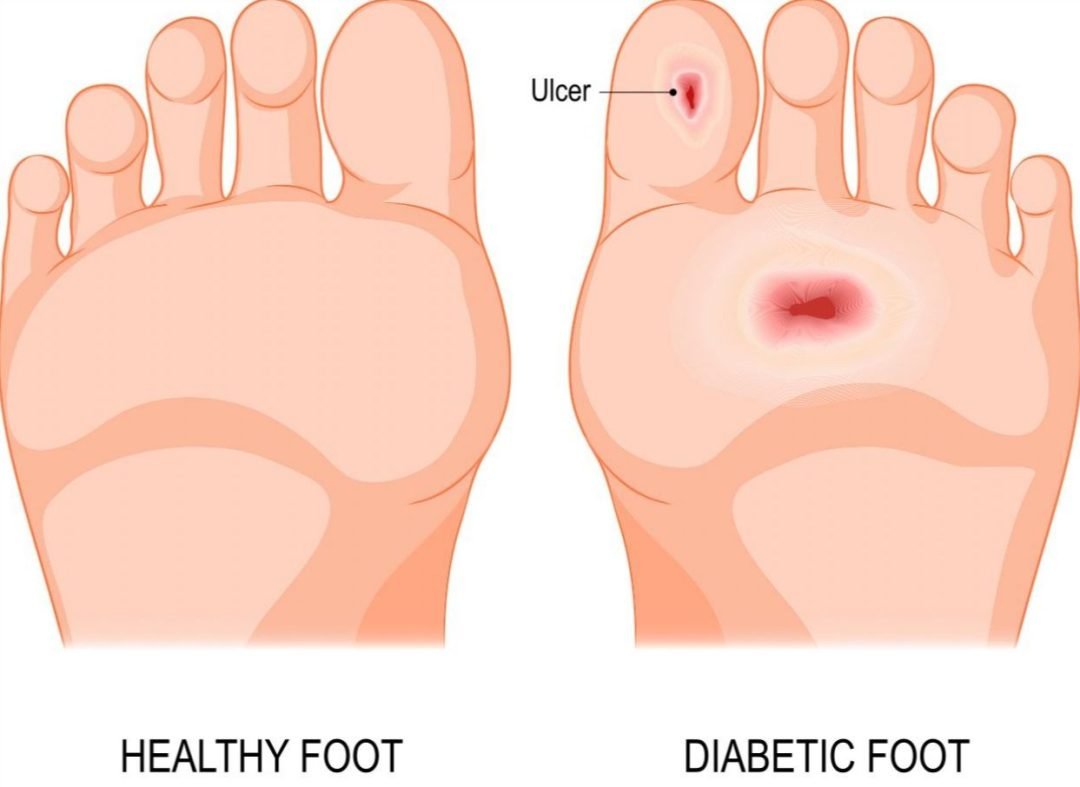 featured image_why you should take diabetic foot ulcers seriously