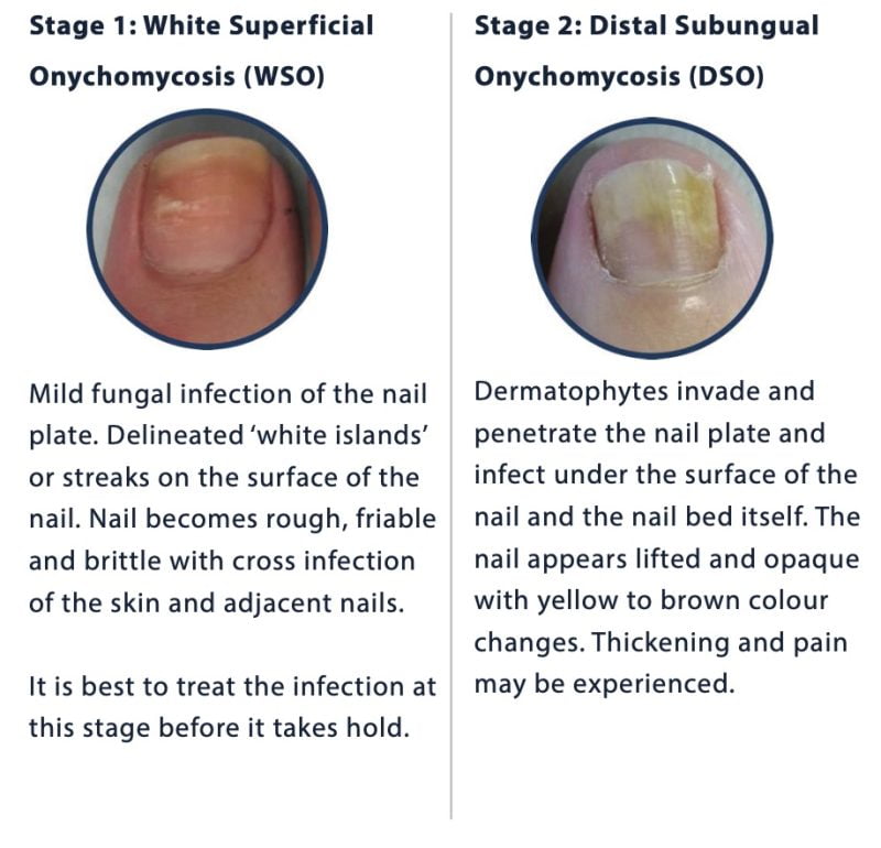stages of toenail fungus_1