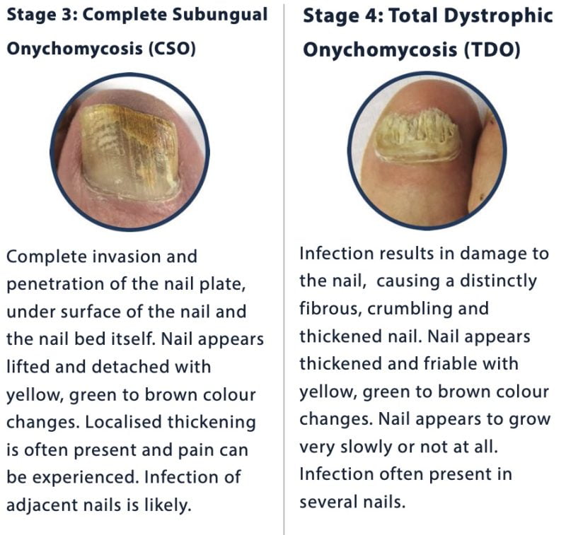 stages of toenail fungus_2