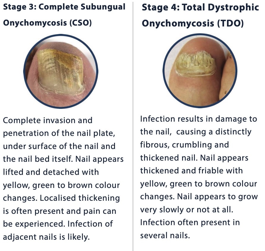 What is a fungal nail infection & how to treat it - Boots