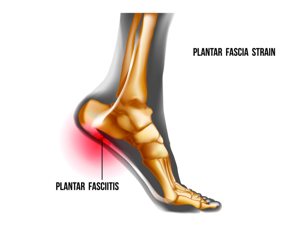 Understanding Plantar Fasciitis: Causes, Symptoms, and Treatment - My FootDr