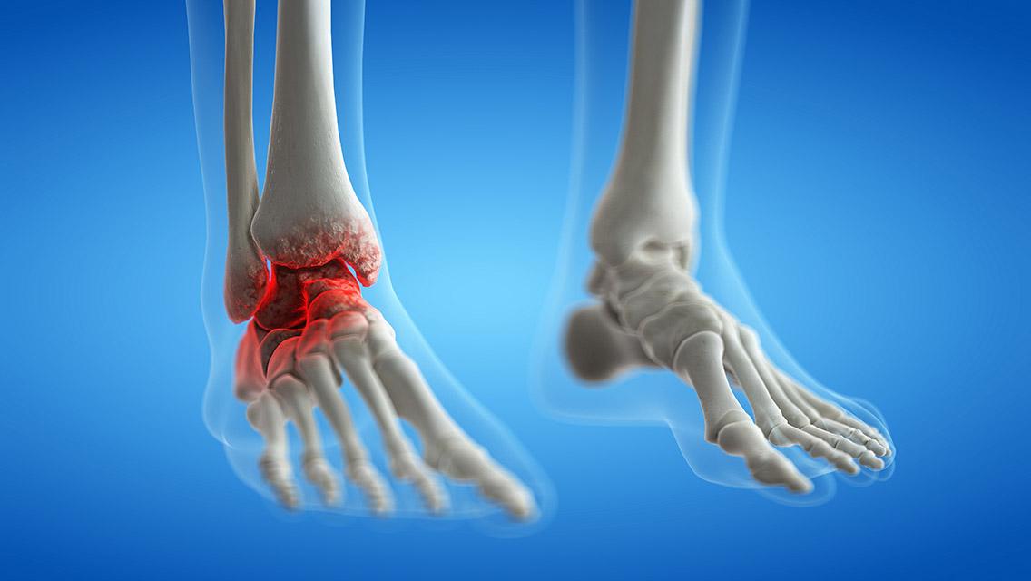 How to Relieve and Prevent Foot and Ankle Arthritis