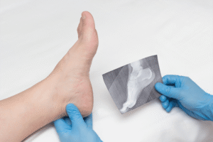 Plantar fasciitis surgery