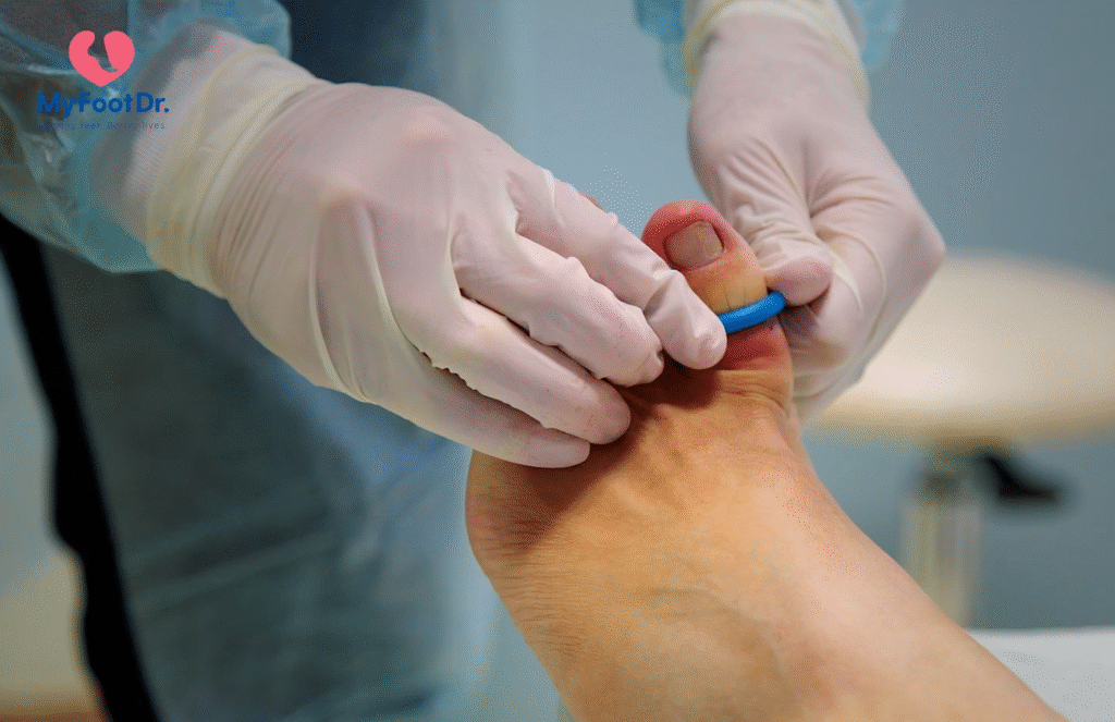 ingrown toenail removal