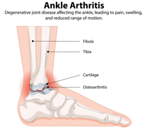 ankle arthritis