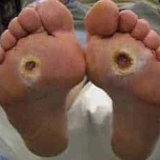Diabetes Ulcer on the foot