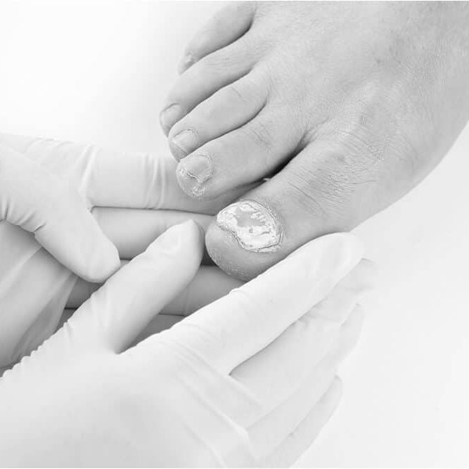 MyFootDr Singapore - Managing Conditions: Fungal Nails Infection