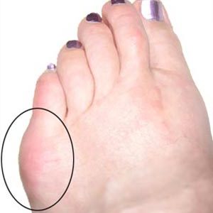 Tailor's Bunions circled in black