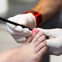 Foot Laser Care Management being carried out