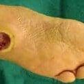 a picture of a leg suffering from Diabetic Foot Ulcer